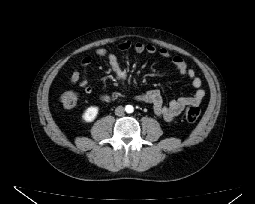 Carcinoid tumor with hepatic metastases (Radiopaedia 22651-22670 B 51).jpg