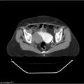 Carcinoma cervix- recurrence (Radiopaedia 34702-36137 B 84).jpg
