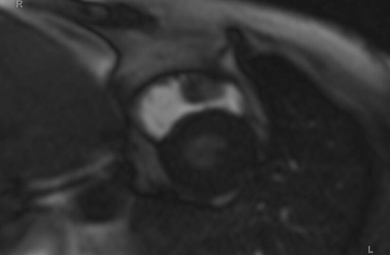 File:Cardiac hemangioma (Radiopaedia 31709-32631 Short axis 99).jpg