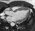Cardiac sarcoidosis (Radiopaedia 39811-42243 LVOT cine images 11).jpg
