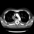 Cardiac tamponade (Radiopaedia 78607-91368 Axial C+ CTPA 22).jpg