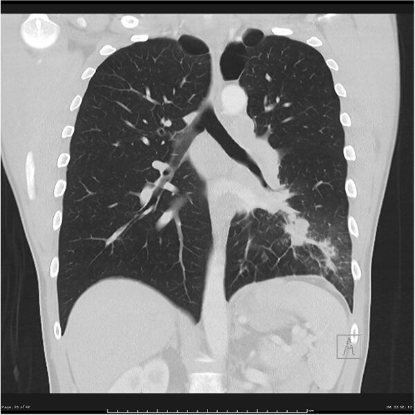 File:Cavitating lung cancer (Radiopaedia 25796-25945 lung window 25).jpg