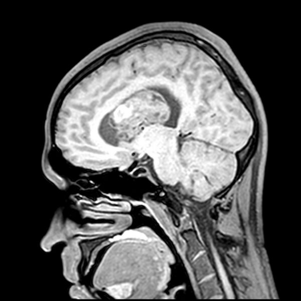 File:Central neurocytoma (Radiopaedia 79320-92380 Sagittal T1 146).jpg