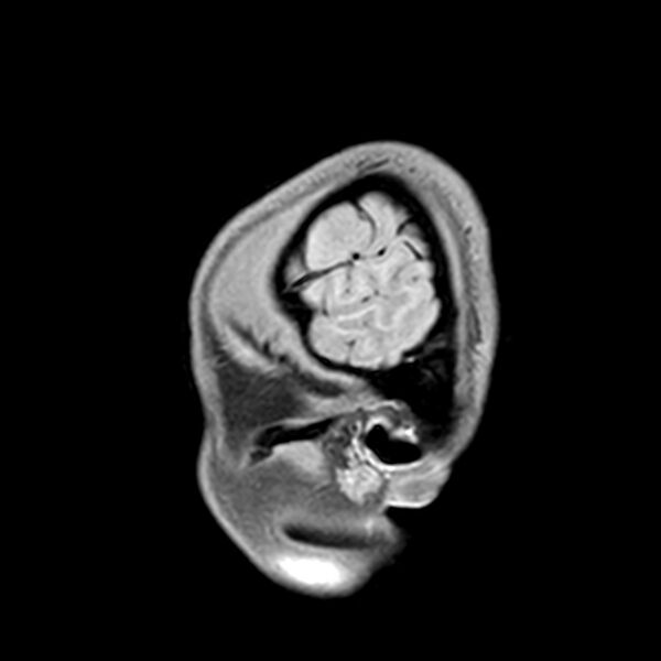 File:Central neurocytoma (Radiopaedia 79320-92380 Sagittal T1 26).jpg