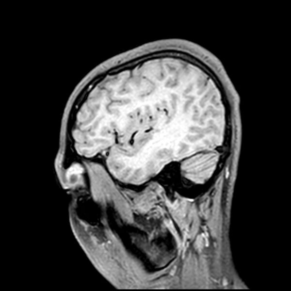 File:Central neurocytoma (Radiopaedia 79320-92380 Sagittal T1 60).jpg