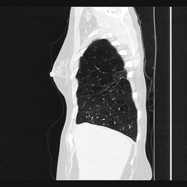 File:Centrilobular pulmonary emphysema (Radiopaedia 24495-24789 Sagittal lung window 11).jpg