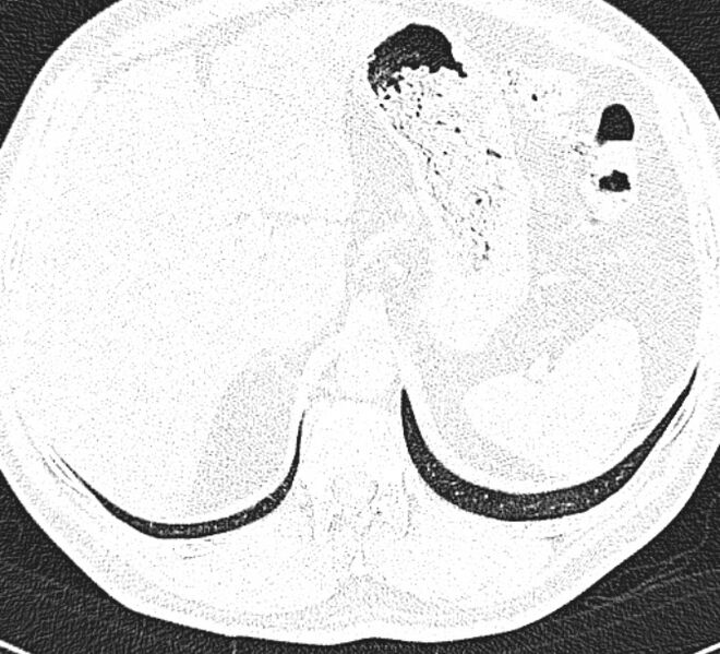 File:Centrilobular pulmonary emphysema (Radiopaedia 26808-26971 Axial lung window 38).jpg