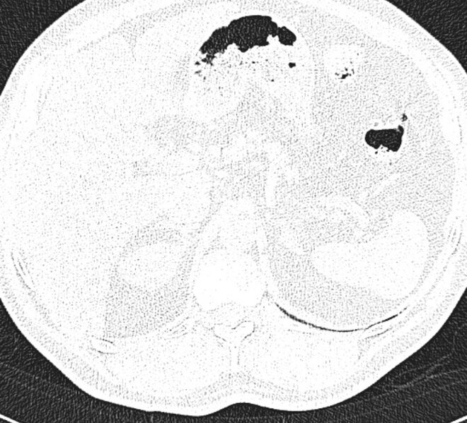 File:Centrilobular pulmonary emphysema (Radiopaedia 26808-26971 Axial lung window 40).jpg