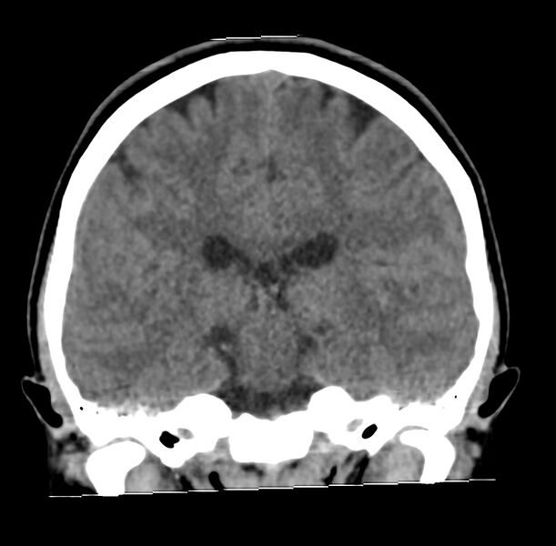 File:Cerebellar agenesis (Radiopaedia 30203-30817 Coronal non-contrast 23).jpg