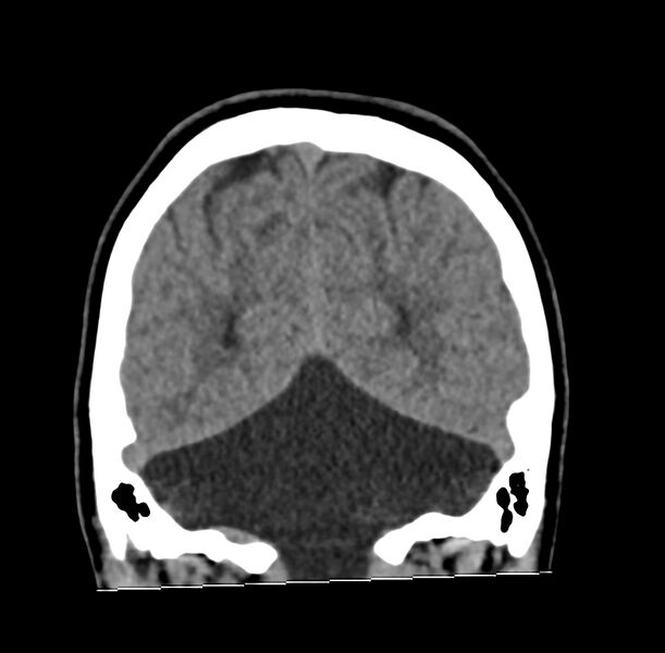 File:Cerebellar agenesis (Radiopaedia 30203-30817 Coronal non-contrast 38).jpg