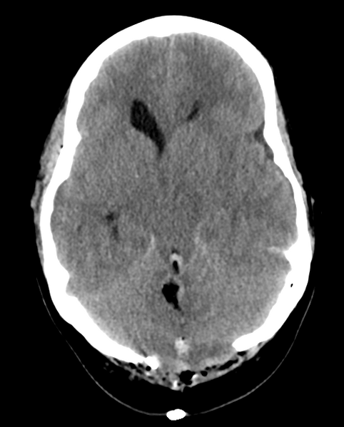 File:Cerebellar ependymoma complicated by post-operative subdural hematoma (Radiopaedia 83322-97737 Axial non-contrast 19).png
