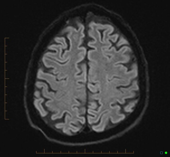 File:Cerebellar gangliocytoma (Radiopaedia 65377-74422 Axial DWI 30).jpg