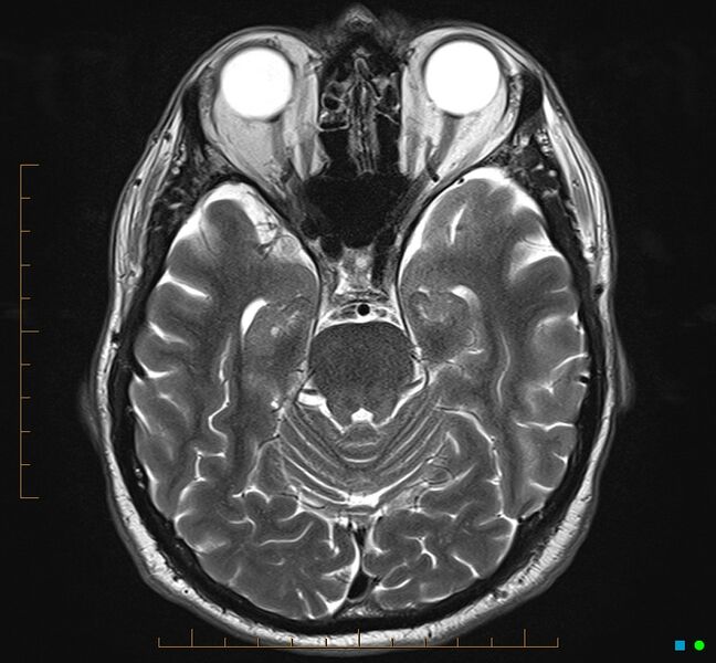 File:Cerebellar gangliocytoma (Radiopaedia 65377-74422 Axial T2 13).jpg