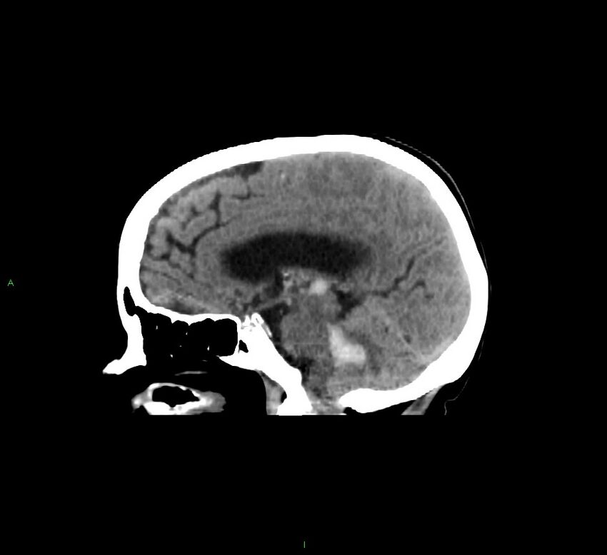 Cerebellar hemorrhage (Radiopaedia 58793-66027 C 25).jpg