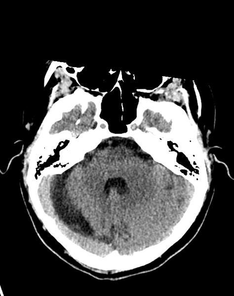 File:Cerebellar infarct due to vertebral artery dissection with posterior fossa decompression (Radiopaedia 82779-97033 Axial non-contrast 11).png