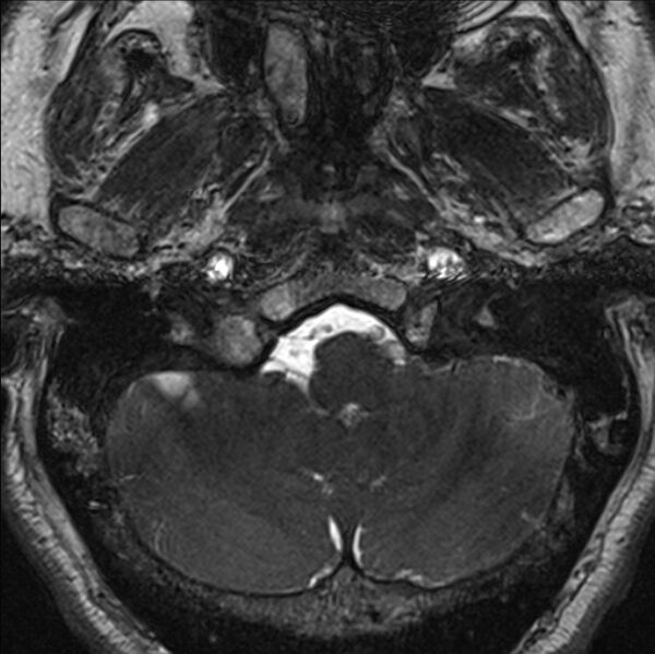 File:Cerebellopontine angle meningioma (Radiopaedia 24459-24764 I 9).jpg