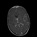 Cerebral abscess post cardiac surgery (Radiopaedia 27244-27420 Axial T1 C+ 12).jpg