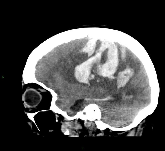 File:Cerebral amyloid angiopathy-associated lobar intracerebral hemorrhage (Radiopaedia 58379-65519 C 18).jpg