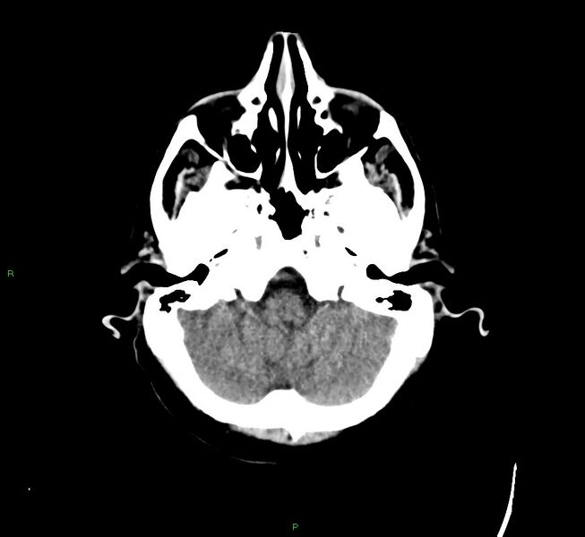 File:Cerebral amyloid angiopathy-associated lobar intracerebral hemorrhage (Radiopaedia 58529-65681 Axial non-contrast 43).jpg