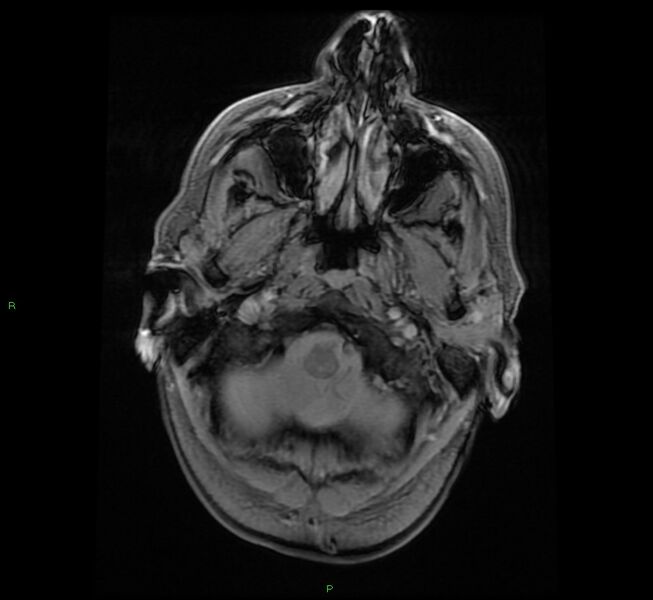 File:Cerebral amyloid angiopathy-associated lobar intracerebral hemorrhage (Radiopaedia 58529-65684 Axial Gradient Echo 3).jpg