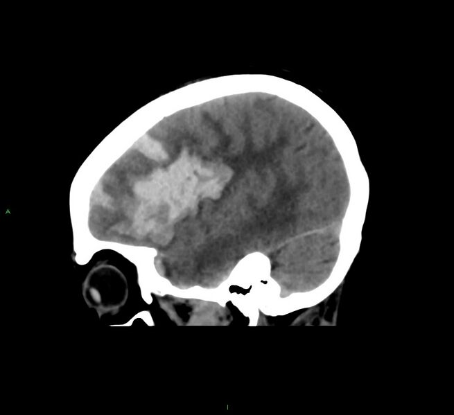 File:Cerebral amyloid angiopathy-associated lobar intracerebral hemorrhage (Radiopaedia 58561-65724 C 37).jpg
