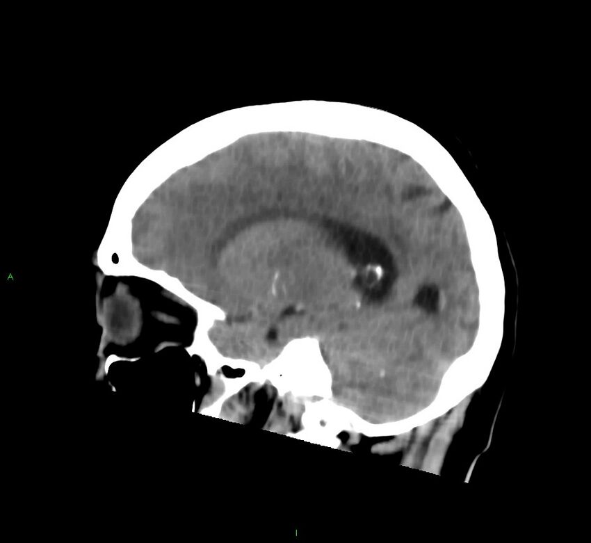 Cerebral amyloid angiopathy-associated lobar intracerebral hemorrhage (Radiopaedia 58752-65973 C 20).jpg