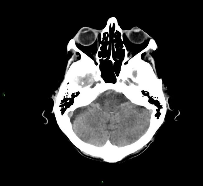 File:Cerebral amyloid angiopathy-associated lobar intracerebral hemorrhage (Radiopaedia 58758-65980 Axial non-contrast 39).jpg