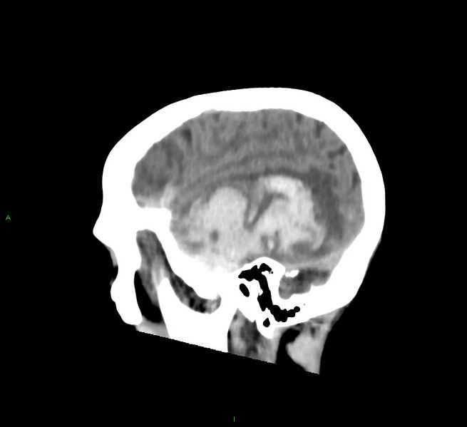 File:Cerebral amyloid angiopathy-associated lobar intracerebral hemorrhage (Radiopaedia 58758-65980 C 12).jpg