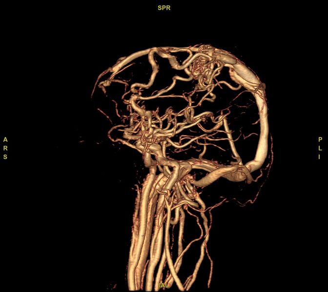 File:Cerebral arteriovenous malformation (Radiopaedia 61964-70029 VRT 50).jpg