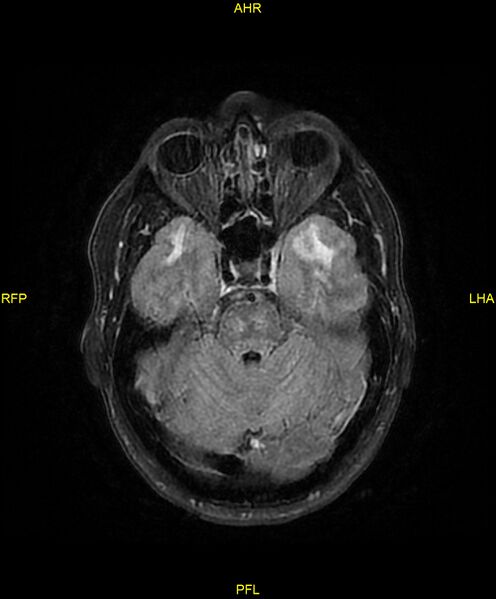 File:Cerebral autosomal dominant arteriopathy with subcortical infarcts and leukoencephalopathy (CADASIL) (Radiopaedia 86108-102054 Axial FLAIR 10).jpg