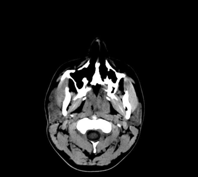 File:Cerebral fat embolism (Radiopaedia 37510-39362 Axial non-contrast 1).jpg