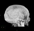 Cerebral hemorrhagic contusions (Radiopaedia 23145-23188 3D MIP 7).jpg