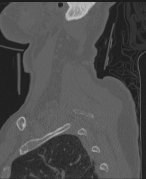 File:Cerebral hemorrhagic contusions and cervical spine fractures (Radiopaedia 32865-33841 Sagittal bone window 9).jpg