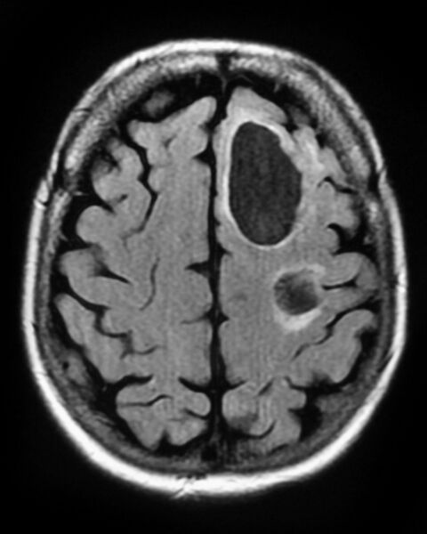 File:Cerebral metastases - small cell lung cancer (Radiopaedia 3972-6521 G 1).jpg