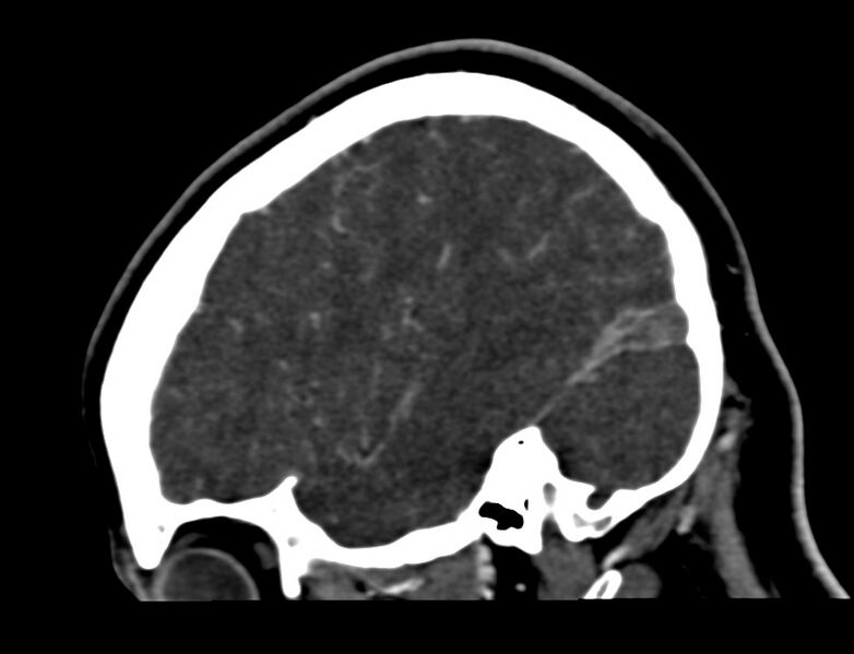 File:Cerebral venous sinus thrombosis (Radiopaedia 59224-66646 Sagittal C+ delayed 52).jpg