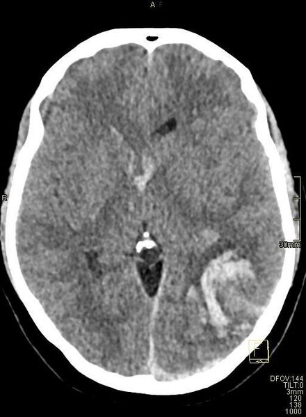File:Cerebral venous sinus thrombosis (Radiopaedia 91329-108965 Axial non-contrast 25).jpg