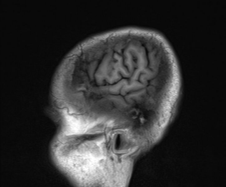 File:Cerebral venous thrombosis (Radiopaedia 71207-81504 Sagittal T1 24).jpg