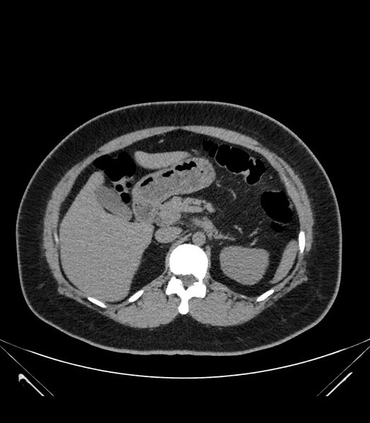 File:Cervical aortic arch with coarctation and aneurysms (Radiopaedia 44035-47552 Axial non-contrast 50).jpg
