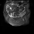 Cervical carcinoma (Radiopaedia 78847-91705 J 2).jpg