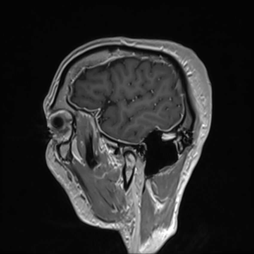 Cervical dural CSF leak on MRI and CT treated by blood patch (Radiopaedia 49748-54995 G 4).jpg