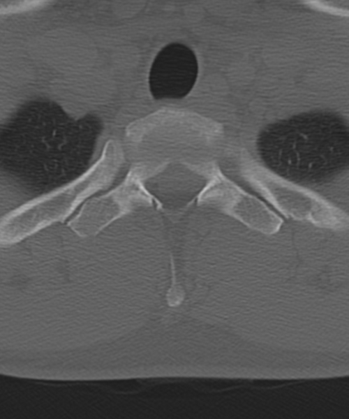 File:Cervical intercalary bone (Radiopaedia 35211-36748 Axial bone window 62).png