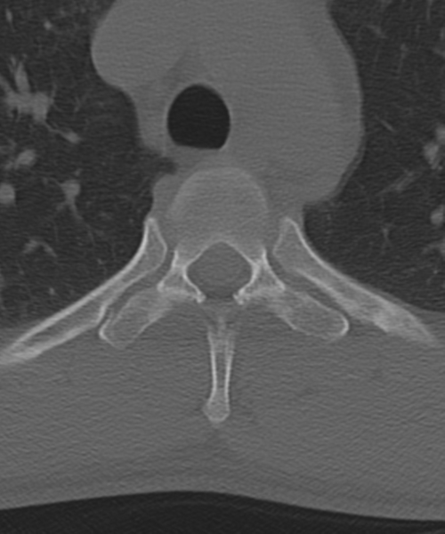 File:Cervical intercalary bone (Radiopaedia 35211-36748 Axial bone window 78).png