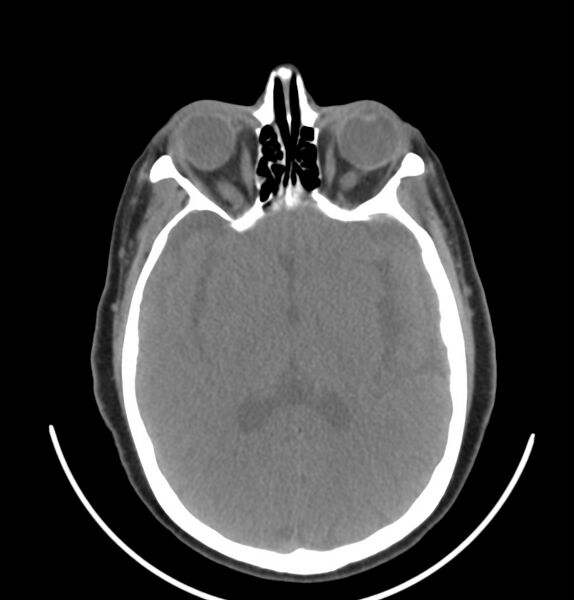 File:Cervical lymphadenopathy- cause unknown (Radiopaedia 22420-22457 non-contrast 46).jpg