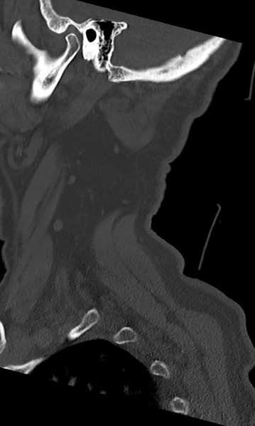 File:Cervical spine fracture - chalk stick (Radiopaedia 39116-41323 Sagittal bone window 55).png