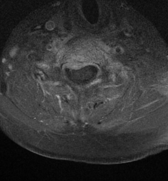 File:Cervical spondylodiscitis (Radiopaedia 81362-95110 Axial T1 C+ fat sat 13).jpg