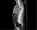 Chance fracture (Radiopaedia 38398-40475 Sagittal bone window 2).jpeg