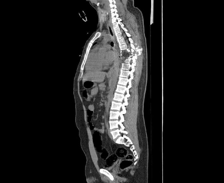 File:Chance fracture (Radiopaedia 38398-40475 Sagittal bone window 2).jpeg
