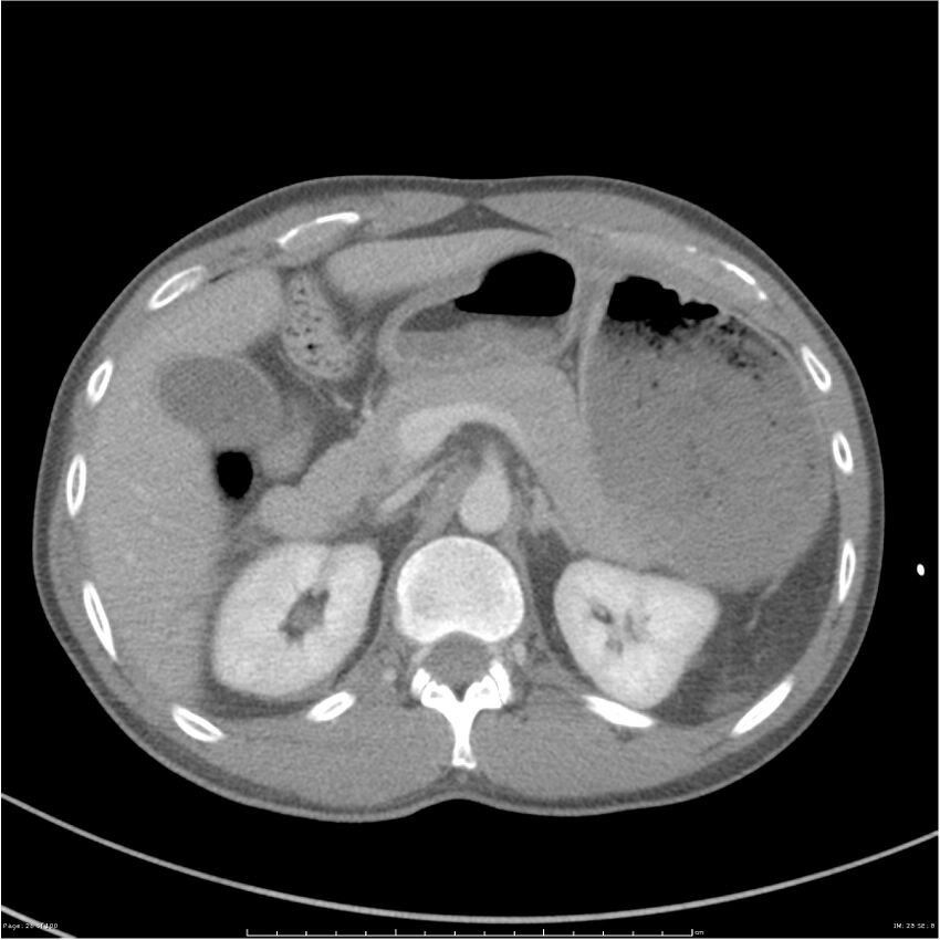 Chest and abdomen multi-trauma (Radiopaedia 26294-26426 bone window 28).jpg