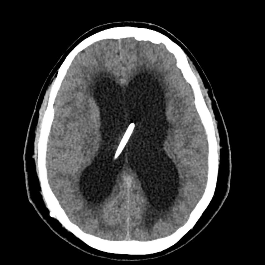 Chiasmatic-hypothalamic juvenile pilocytic astrocytoma (Radiopaedia 78533-91237 Axial non-contrast 34).jpg