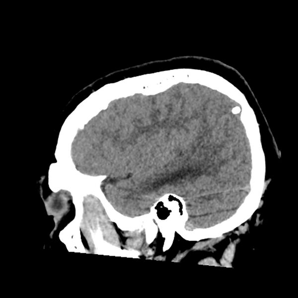 File:Chiasmatic-hypothalamic juvenile pilocytic astrocytoma (Radiopaedia 78533-91237 B 48).jpg